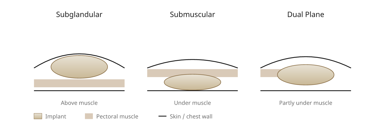 Where the Implant Sits: Placement Options
